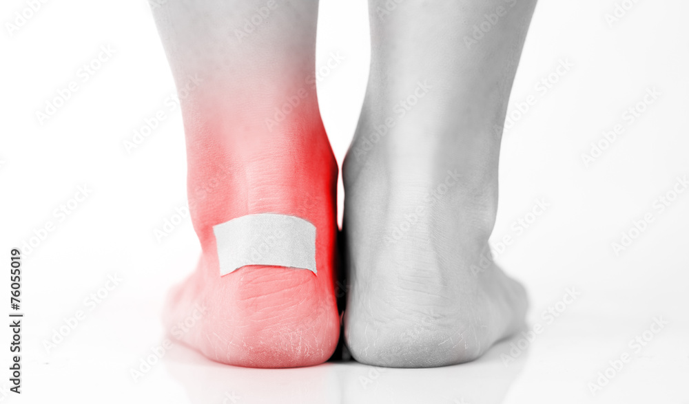 Closeup of womans heel with blister plaster on