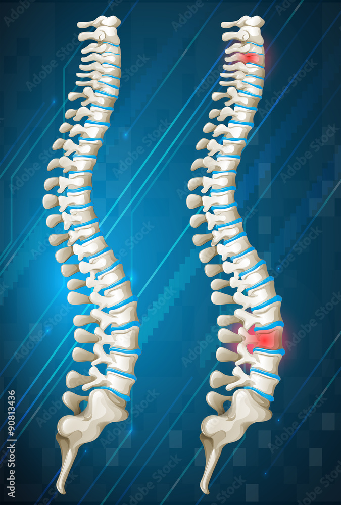 Human spines with red inflamed on one