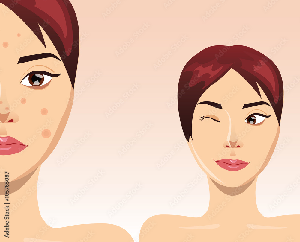 Acne treatment= with beautiful woman face, vector illustration