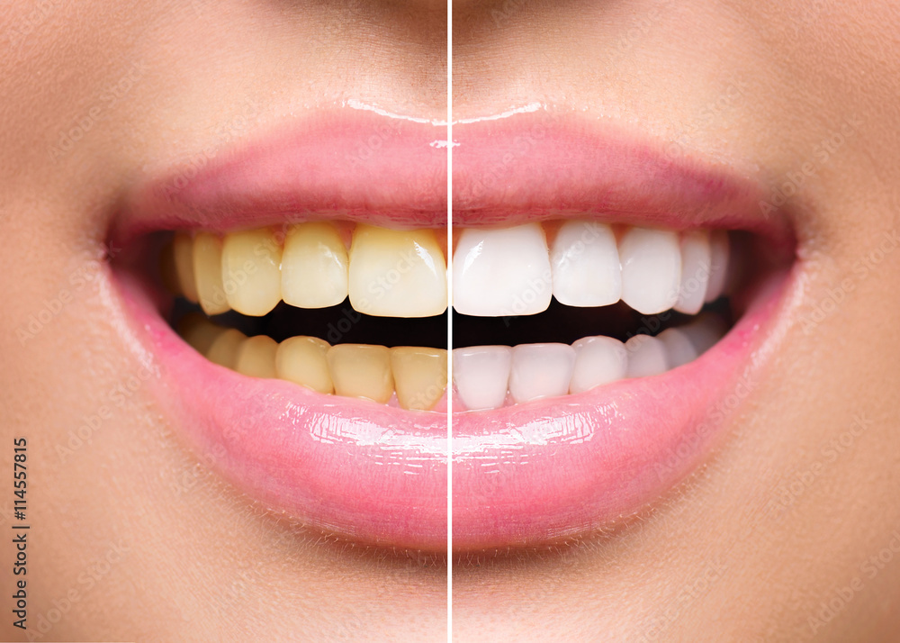 Woman teeth before and after whitening. Oral care