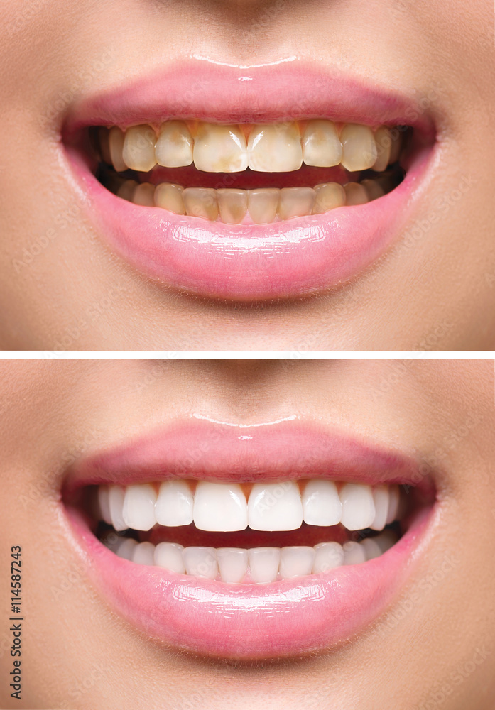 Woman teeth before and after whitening. Oral care