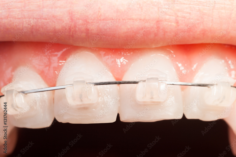 Top tooth alignment with ceramic braces