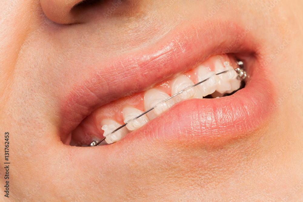 Man showing orthodontics correction of jaws