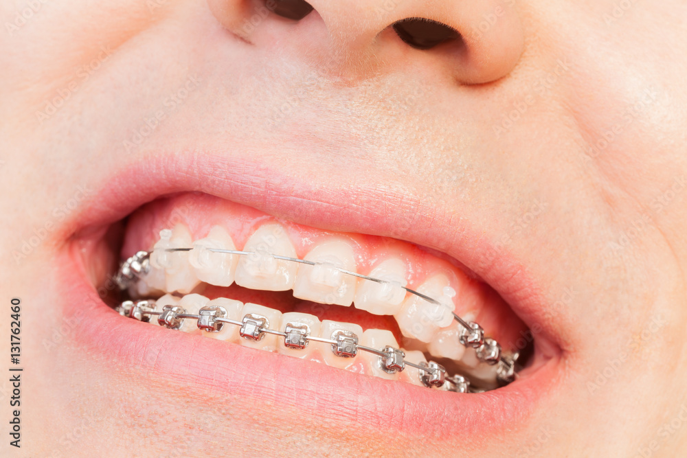 Mans smile with orthodontic braces