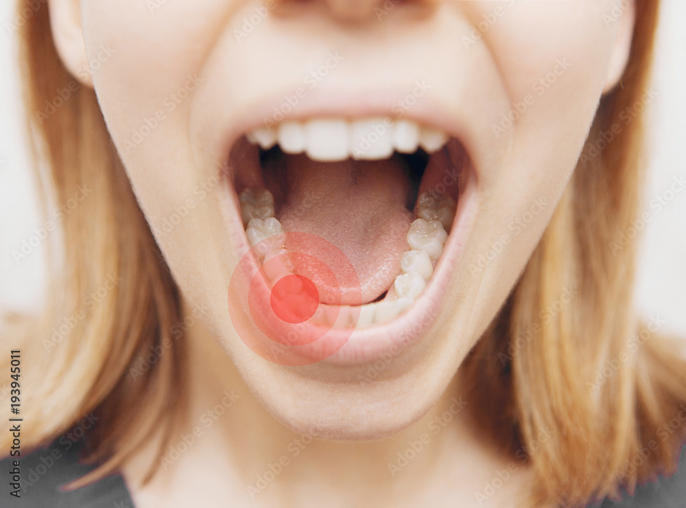 Mal di senti, bocca aperta con dente cariato