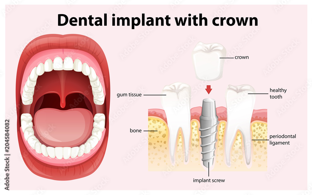 牙冠矢量种植体