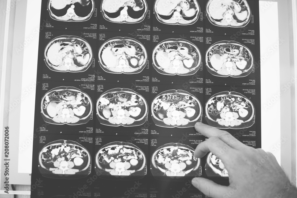 Brain CT scan x-ray film