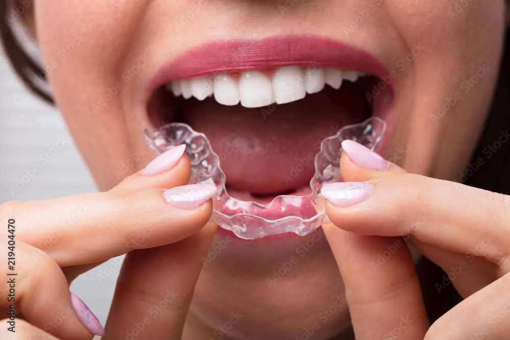 Woman Putting Transparent Aligner In Teeth