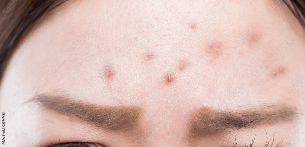 facial acne on forehead