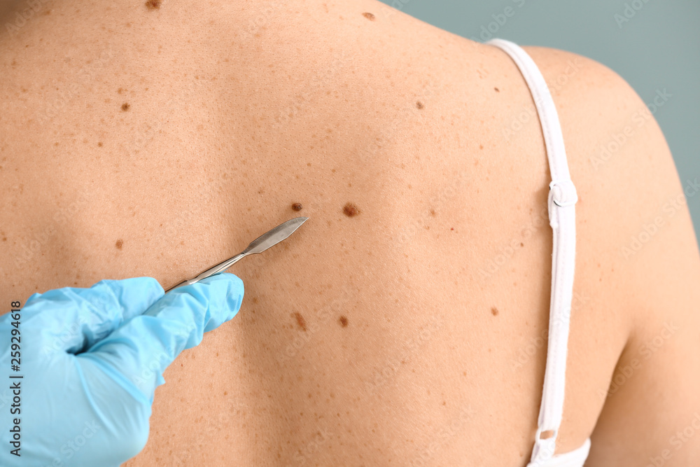 Doctor with lancet going to remove mole from patients skin, closeup