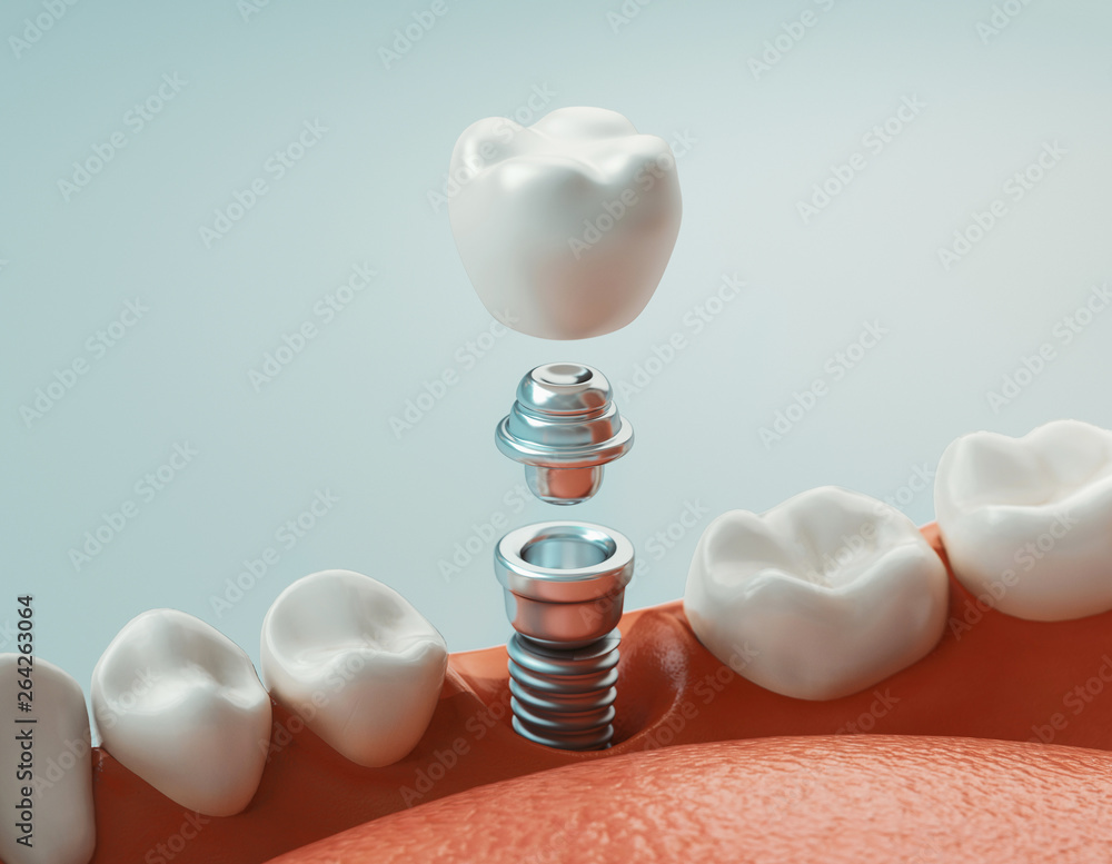 Dental care, dental implant, 3d rendering