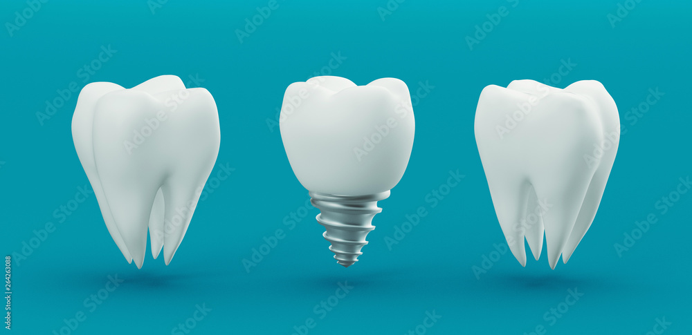 Dental care, dental implant, 3d rendering