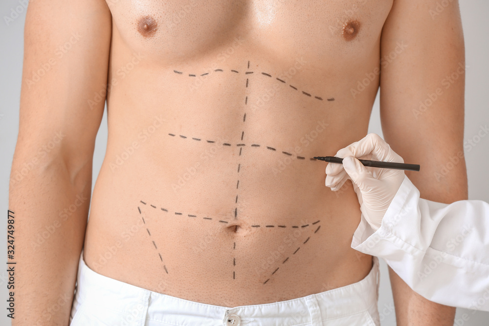 Plastic surgeon applying marking on male body, closeup