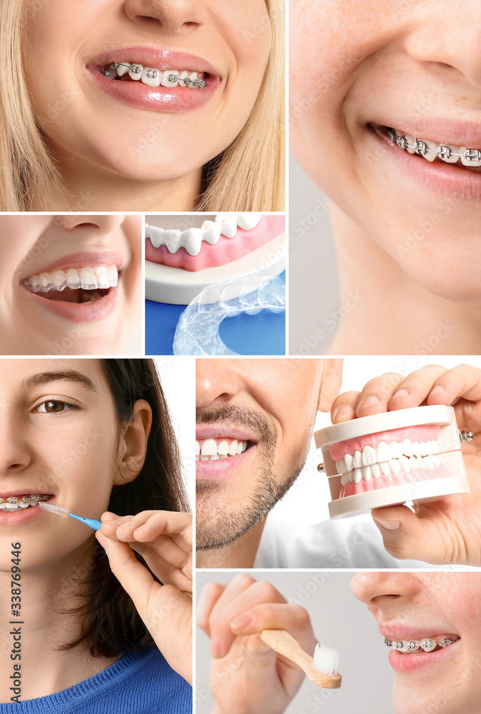 Set of different people with dental braces 