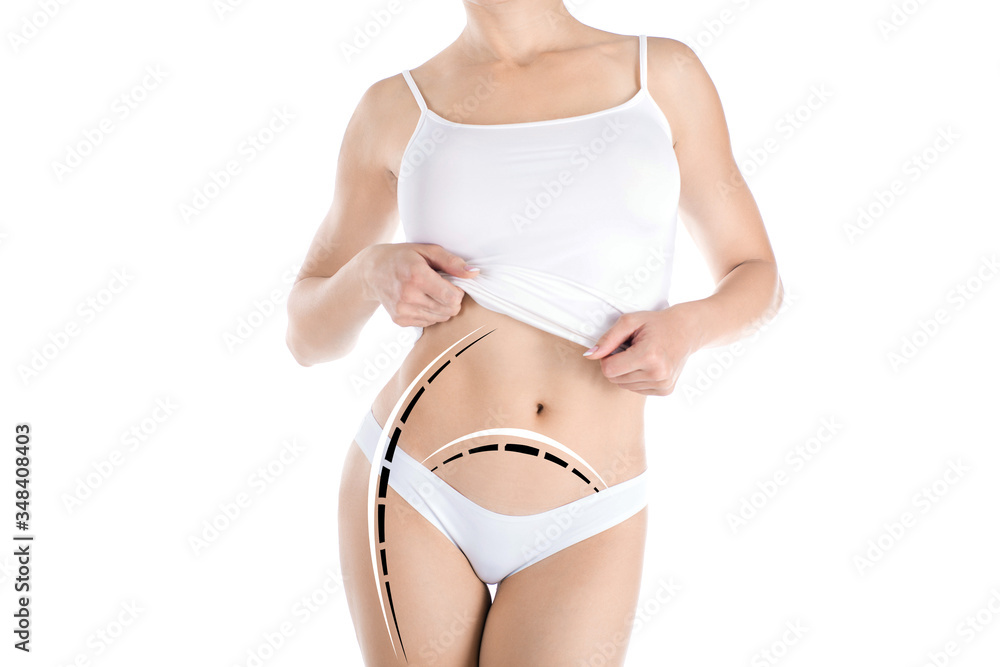 Correction, skin lifting and abdominoplasty. Female beautiful faceless body with marking lines on th