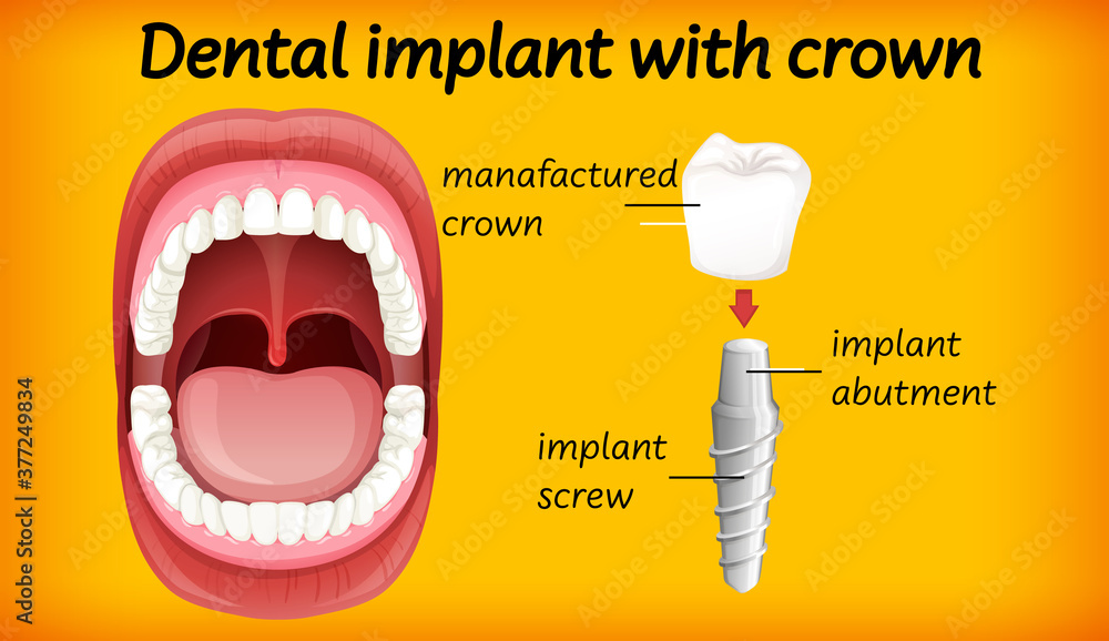 带牙冠的牙科植入物