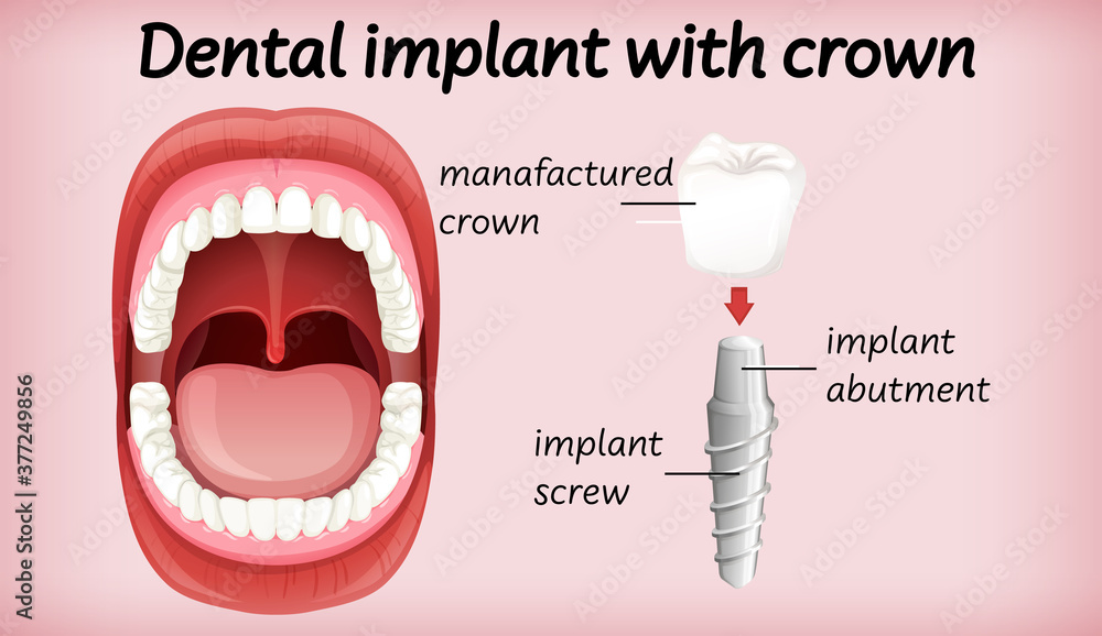 带牙冠的牙科植入物