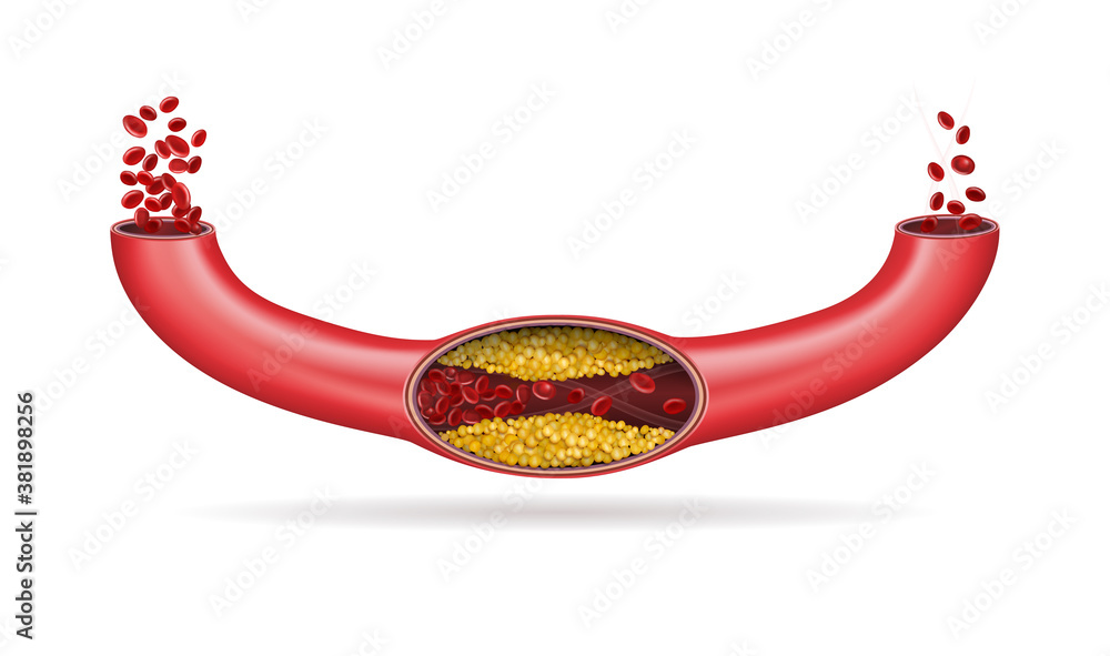 动脉被胆固醇堵塞。矢量图
