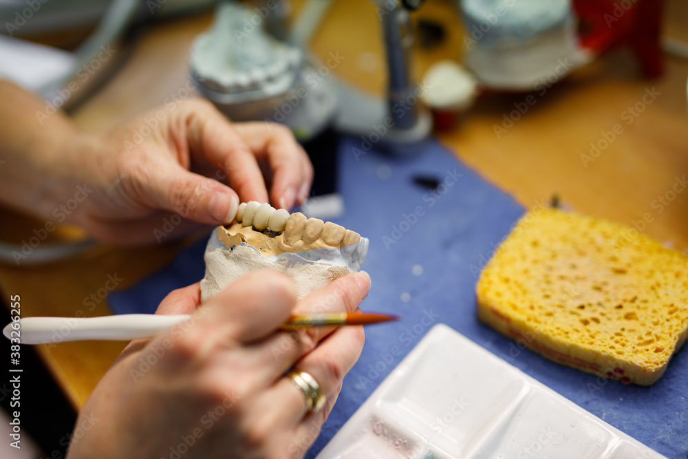 Working on a patients dental casting. Fitting artificial dentition.