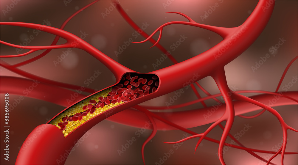 胆固醇阻断动脉。矢量图