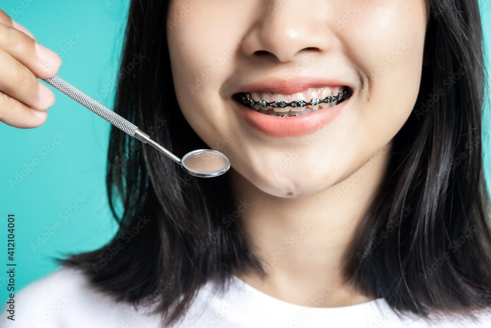 Asian woman wearing dental braces pointing to tooth sample and smiling with her healthy white teeth 