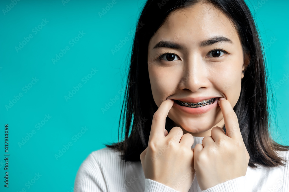 Asian woman wearing dental braces pointing to tooth sample and smiling with her healthy white teeth 