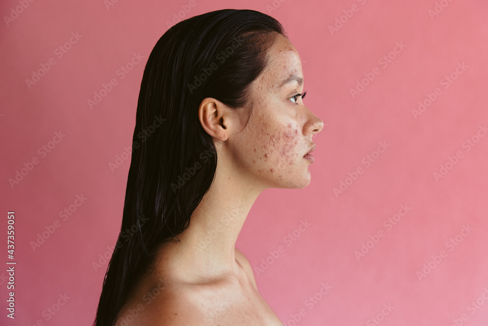 Portrait of woman with skin problem