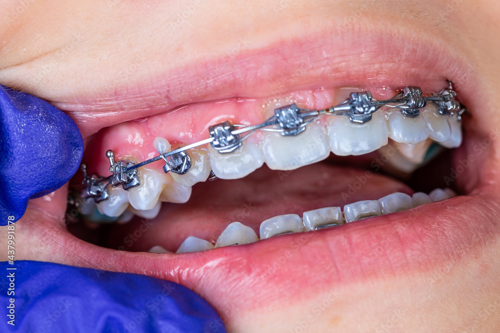 Close up dental braces system.