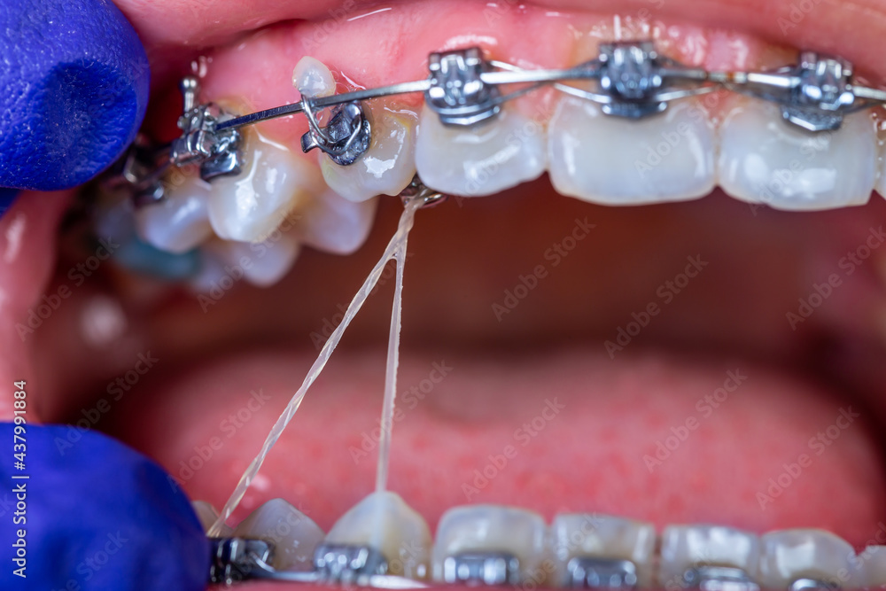 Close up dental braces system.