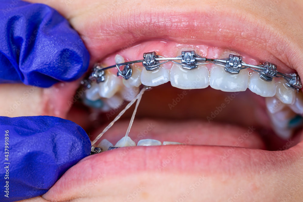 Close up dental braces system.