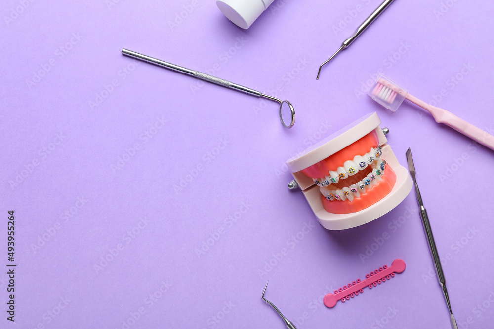 Model of jaw with dental braces and dentist tools on lilac background