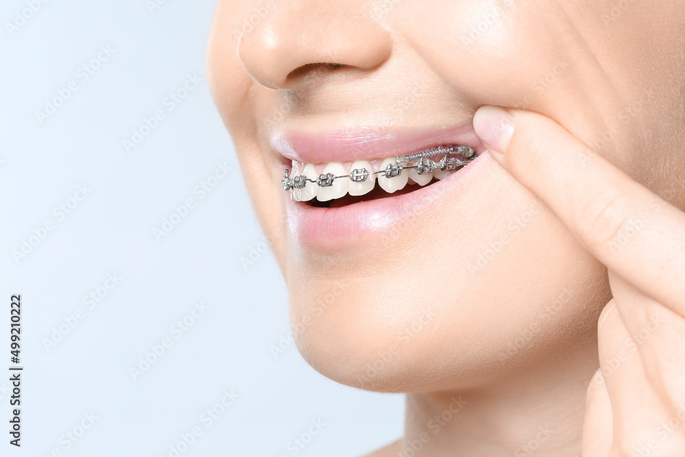 Woman with dental braces on light background, closeup