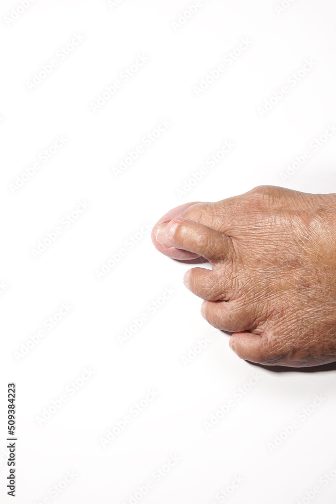 Broken, crooked toes of an elderly woman caused by an accident.