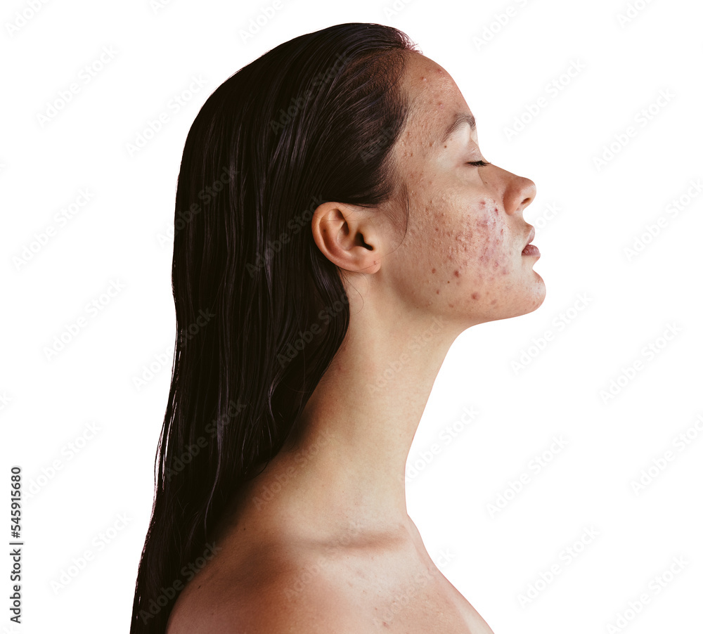 Young woman with inflammatory acne isolated on a transparent background