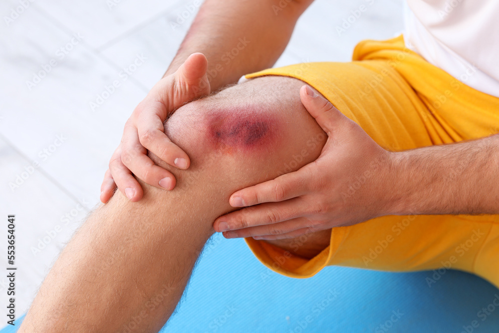 Sporty man with bruise on body training in gym, closeup