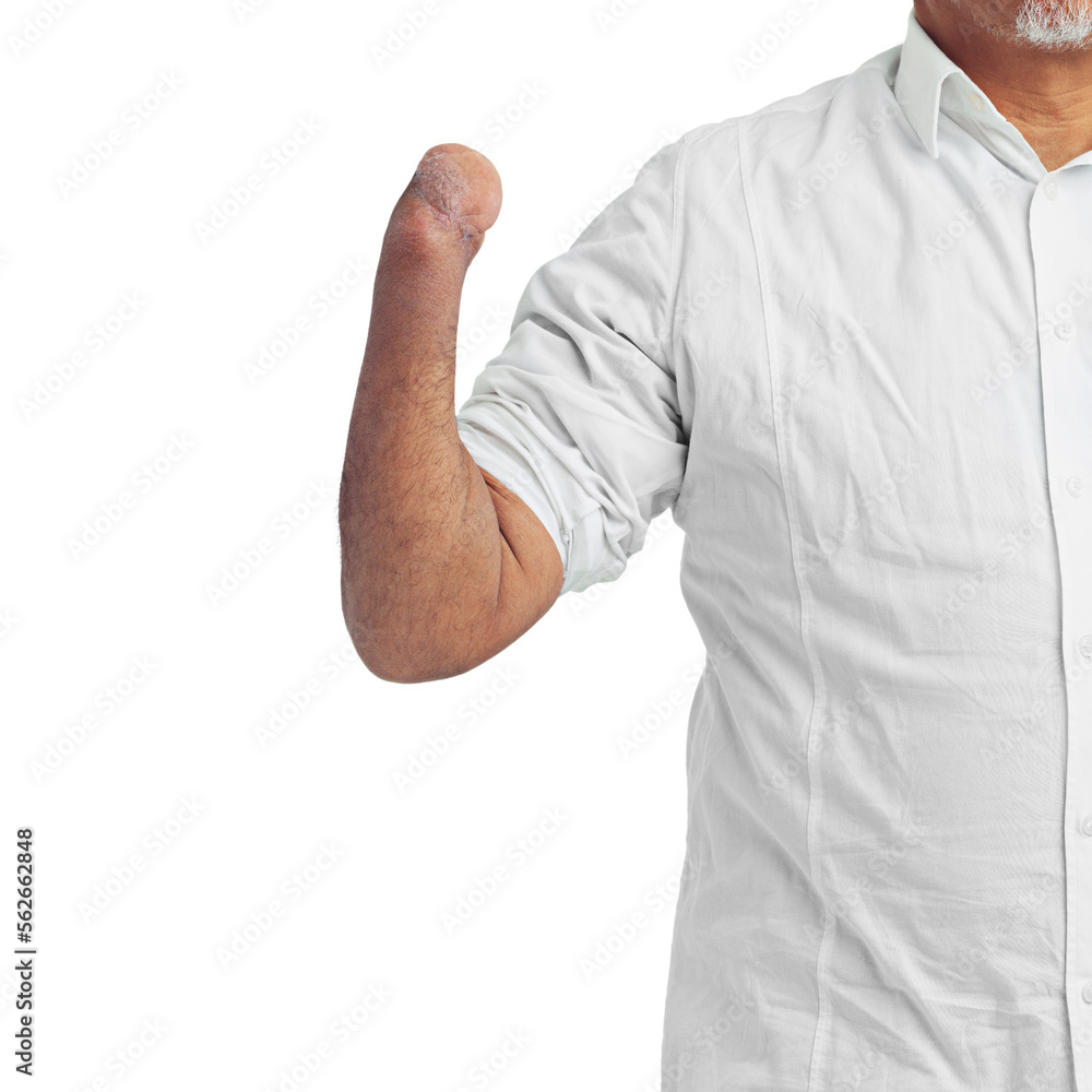 Disability, injury and arm of an injured amputee isolated on a white background in studio. Disabled,