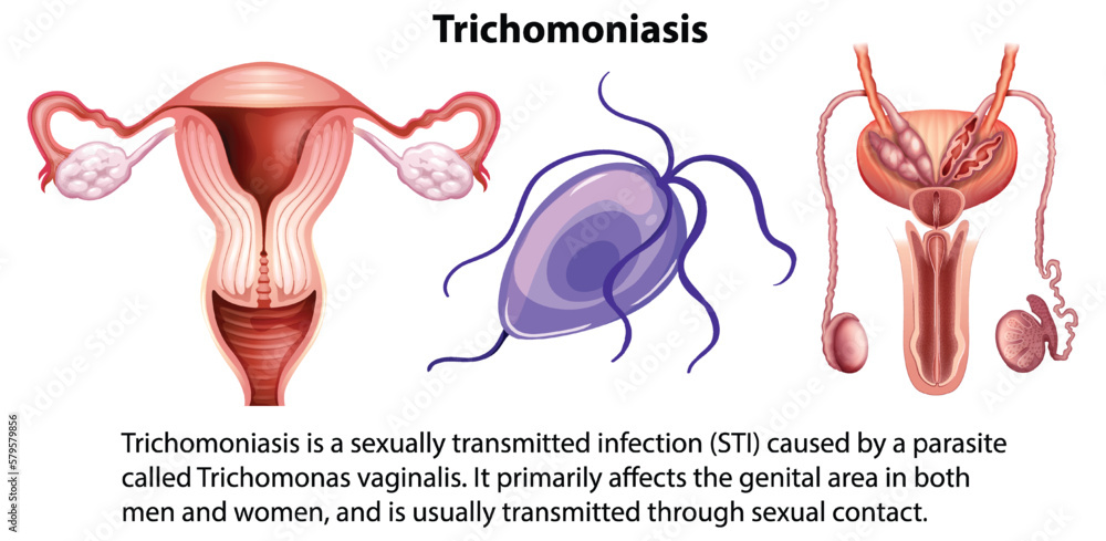 Trichomoniasis infographic with explanation