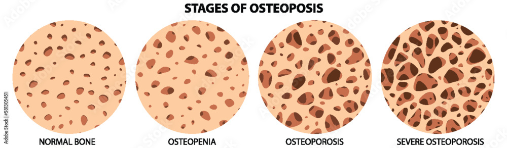 Stages of Osteoposis Vector