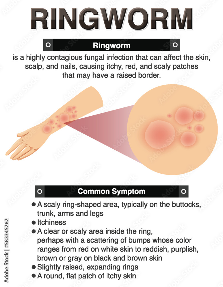 Informative symptoms of Ringworm