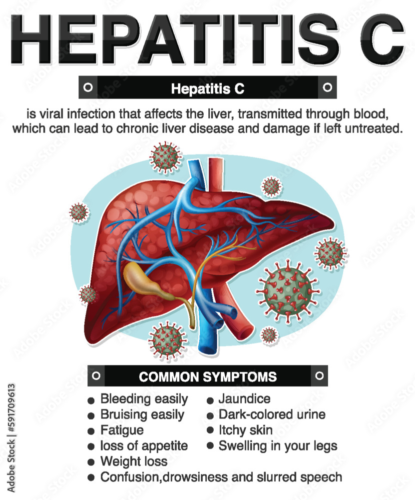 Symptoms of Hepatitis C Infographic