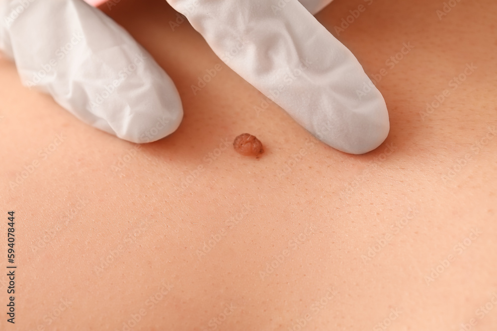 Dermatologist examining mole on young mans back, closeup