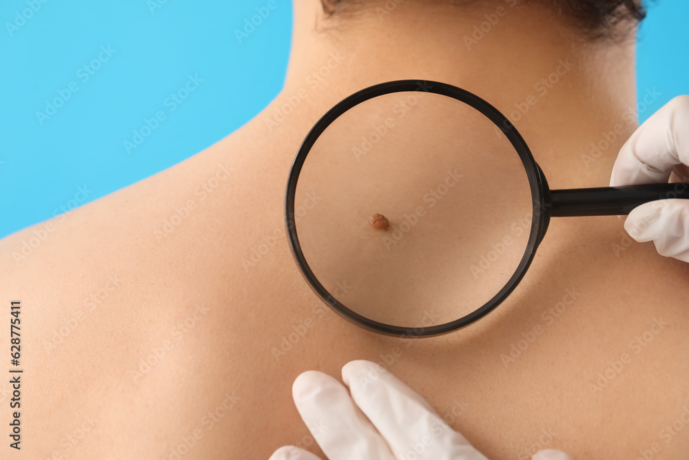 Dermatologist examining mole on young mans back with magnifier against blue background, closeup