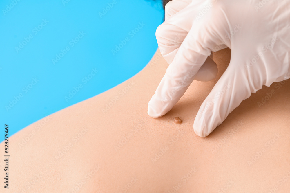 Dermatologist examining mole on young mans back against blue background, closeup