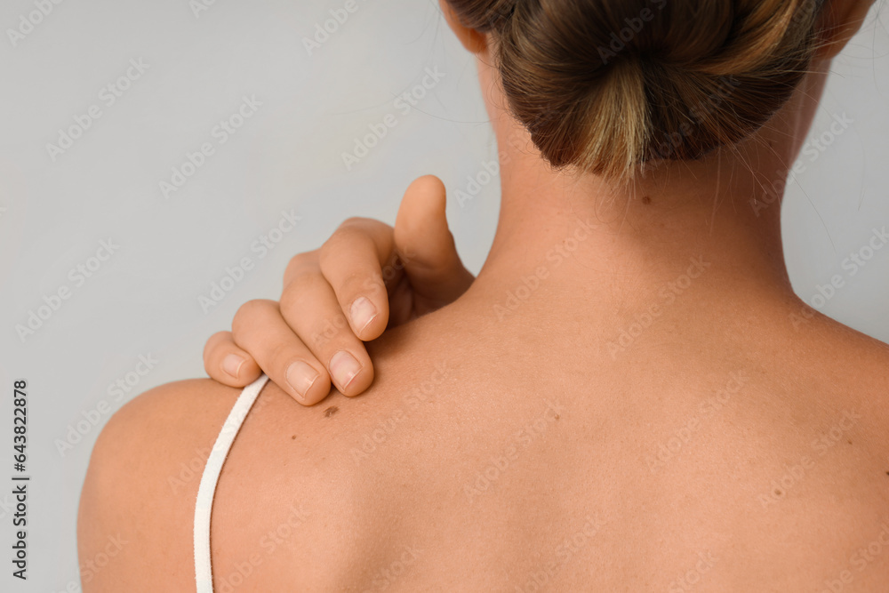 Young woman with moles on light background, back view