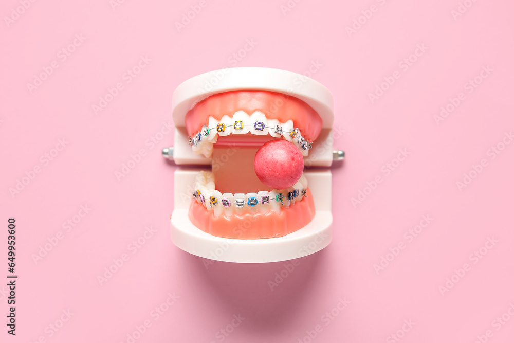 Model of jaw with dental braces and chewing gum on pink background