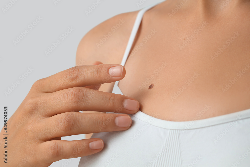 Young woman with moles on light background, closeup