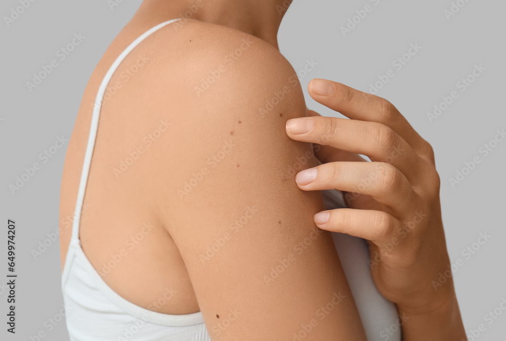 Young woman with moles on light background, closeup