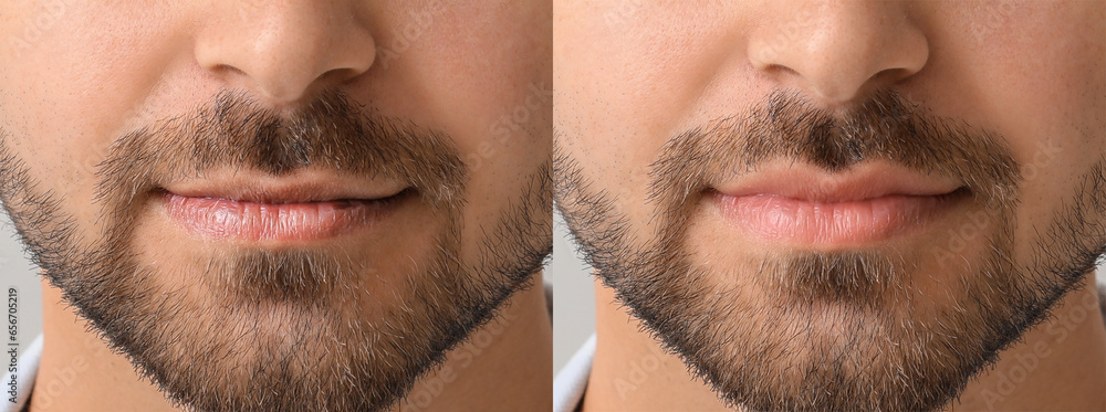 Young man before and after lip enhancement, closeup