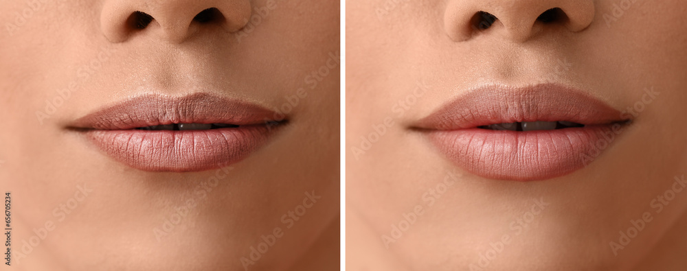 Young transgender woman before and after lip enhancement, closeup