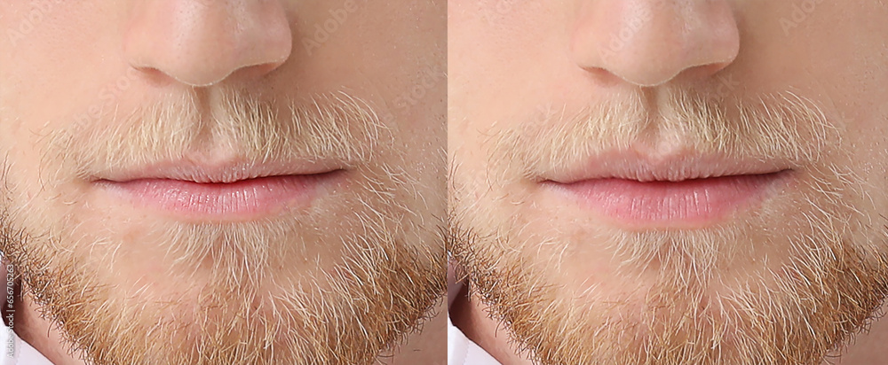 Young man before and after lip enhancement, closeup